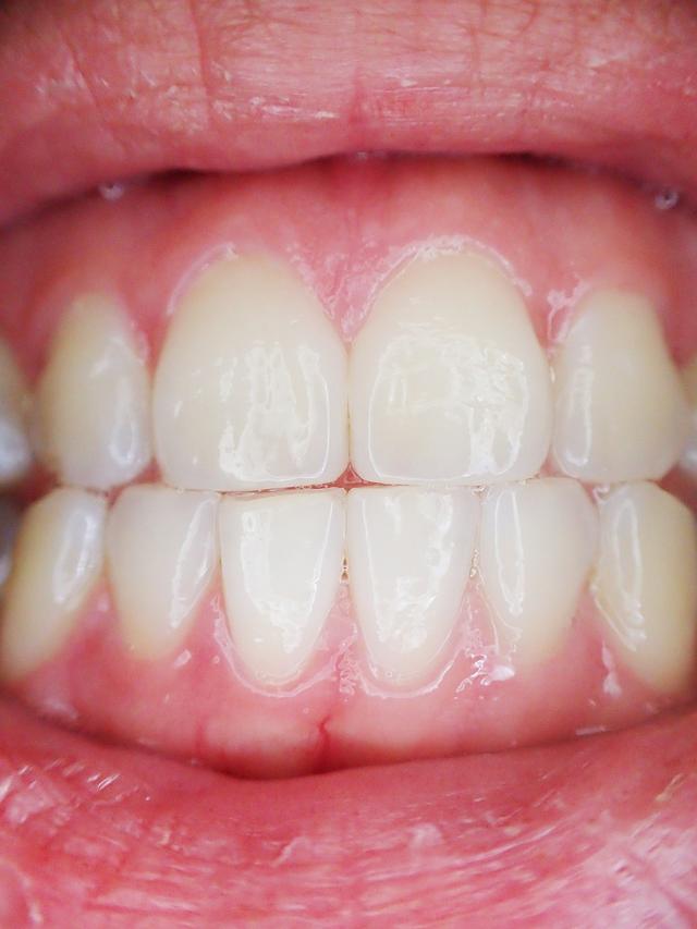 To have healthy teeth and <span class="blank">______</span>, we should brush our teeth twice a day.