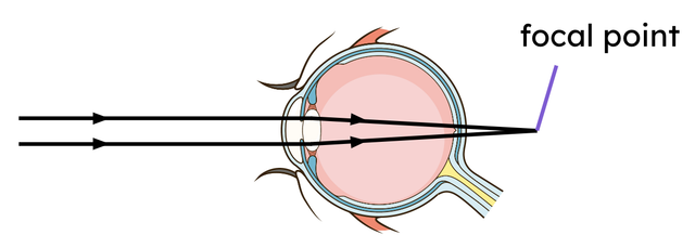 Which common eye defect is shown below?